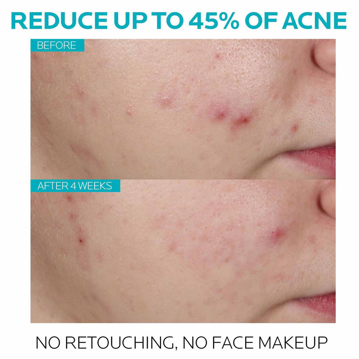effaclar-salicylic-acid-acne-treatment-serum-i9 7_EffaclarSerum_After-45-days.jpg 7_EffaclarSerum_After-45-days_861b20986157.jpg
