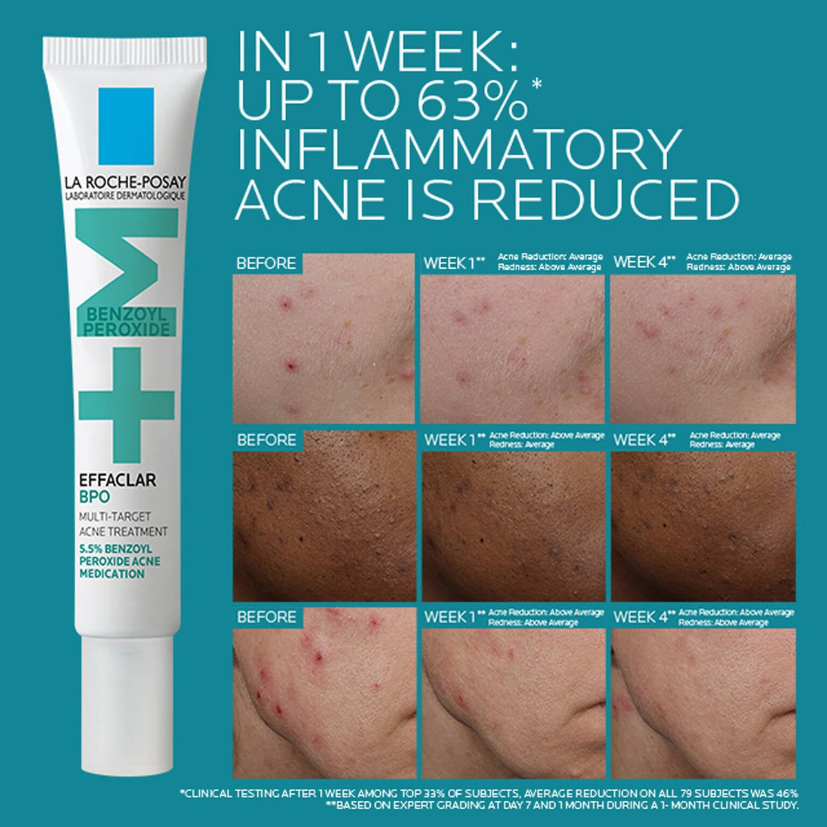 effaclar-bpo-multi-target-acne-treatment-with-5-5-benzoyl-peroxide-c8 EffaclarBPO-ClinicalBA-ATF-1500x1500-2.jpg EffaclarBPO-ClinicalBA-ATF-1500x1500-2_24504e8de09c.jpg