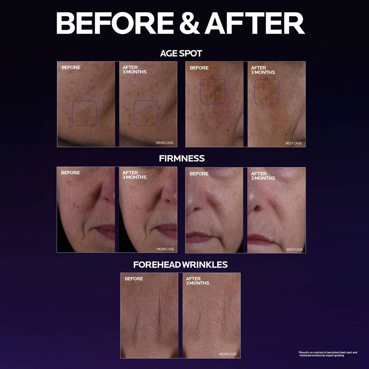 mela-b3-double-dose-discoloration-treatment-with-melasyltm-d4 MelaB3_DD_BTF_BeforeAfter_1500x1500_5.jpg MelaB3_DD_BTF_BeforeAfter_1500x1500_5_eb9d4f5b0787.jpg